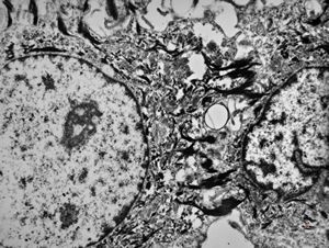 F,31y. | mucoepidermoid carcinoma